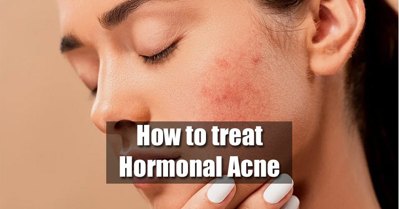 How To Get Rid of Hormonal Acne With Natural Acne Treatments
