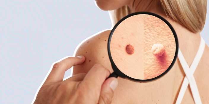 What is the Likelihood of Having Cancerous Skin Tags