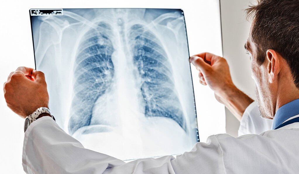 Why do You need a Chest X-ray?
