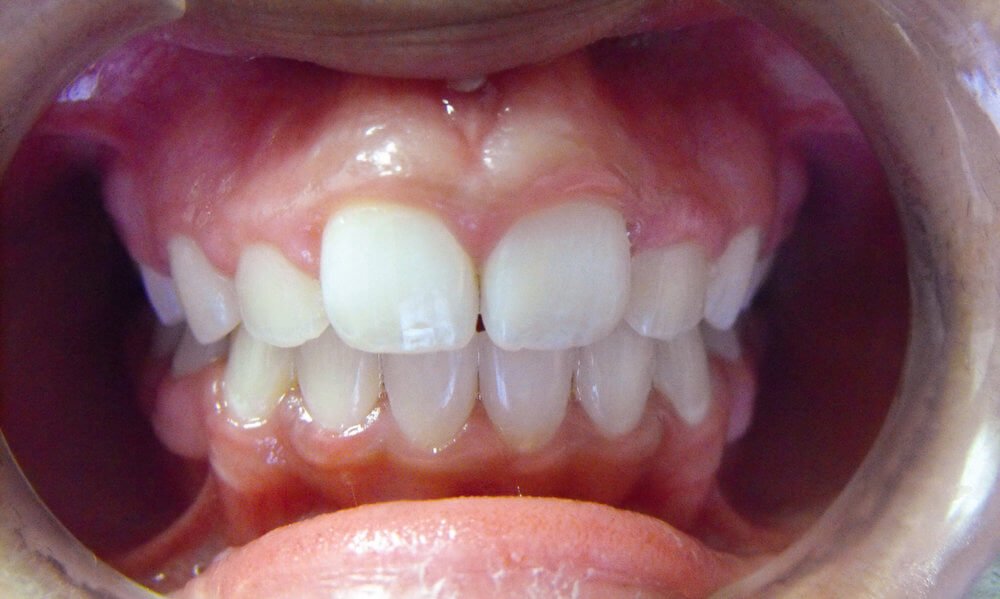 Is it beneficial to have a dental crown if the opposing tooth is being purged?