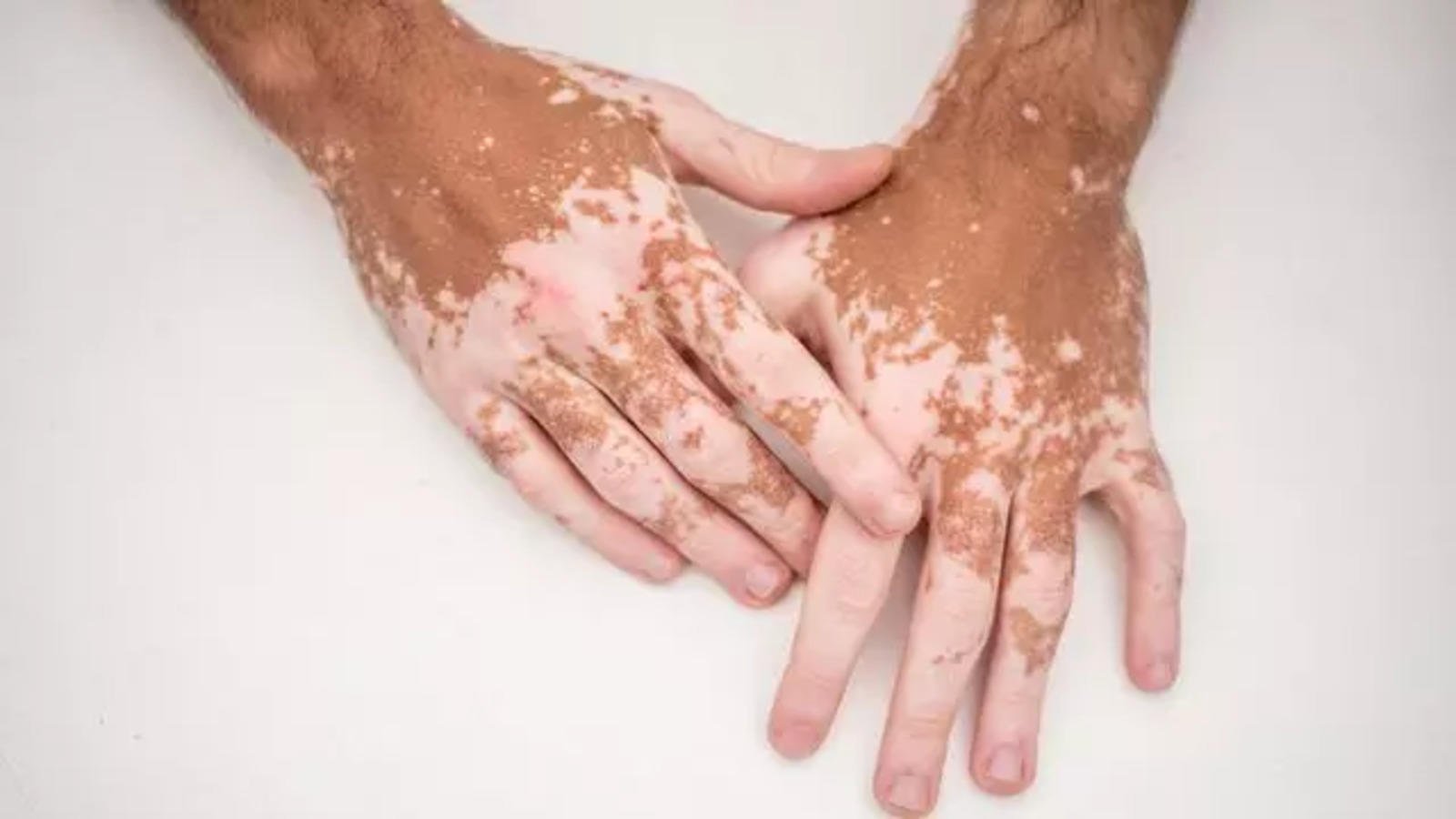 Unveiling the Power of Benoquin Cream in Vitiligo Treatment A