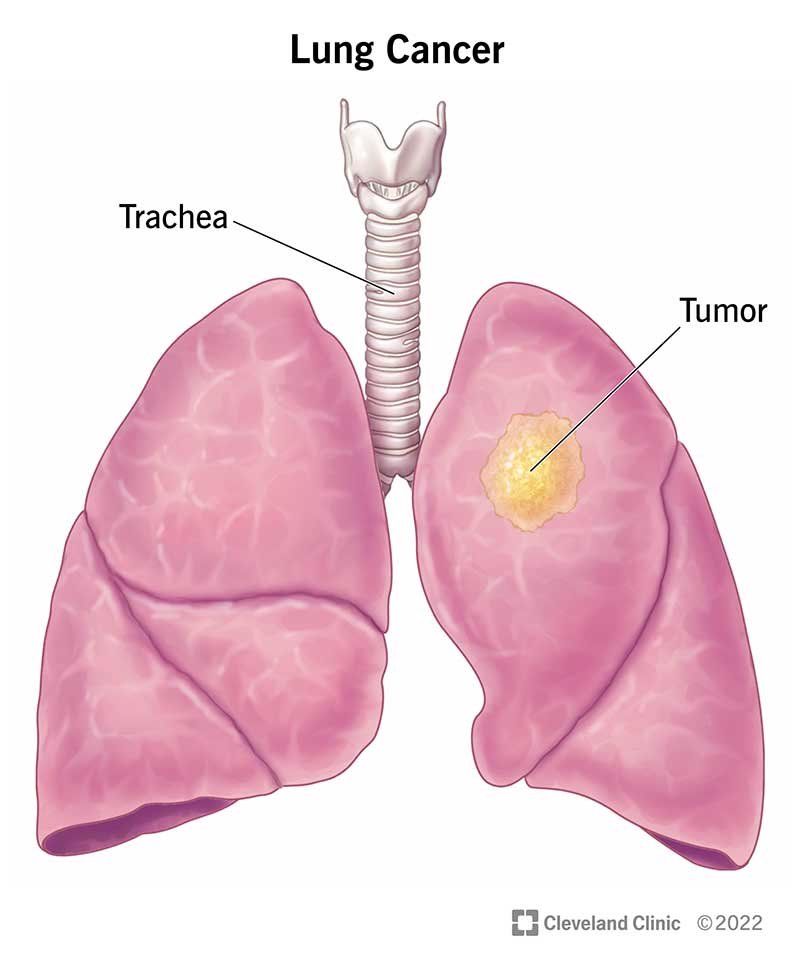 Lung Cancer: Types, Symptoms, Causes, Diagnosis & Treatment