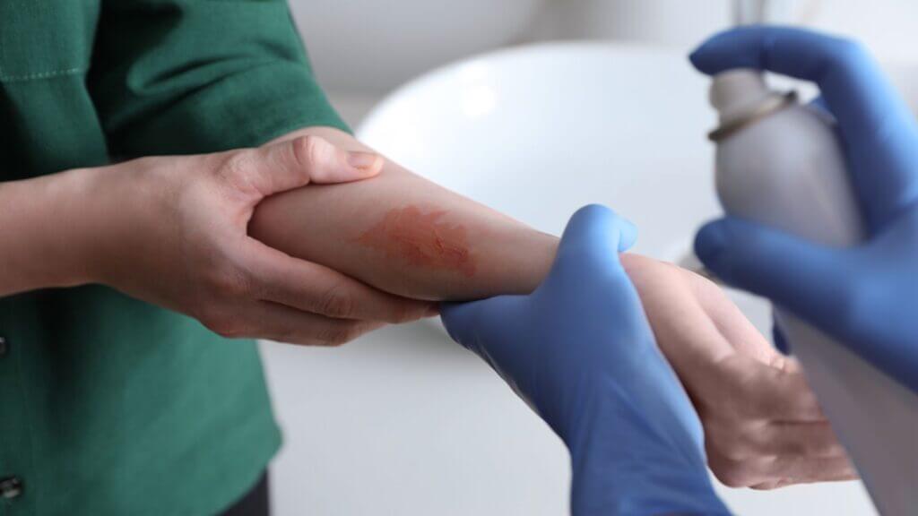 Burn Injuries from Faulty Appliances: Who’s Liable?
