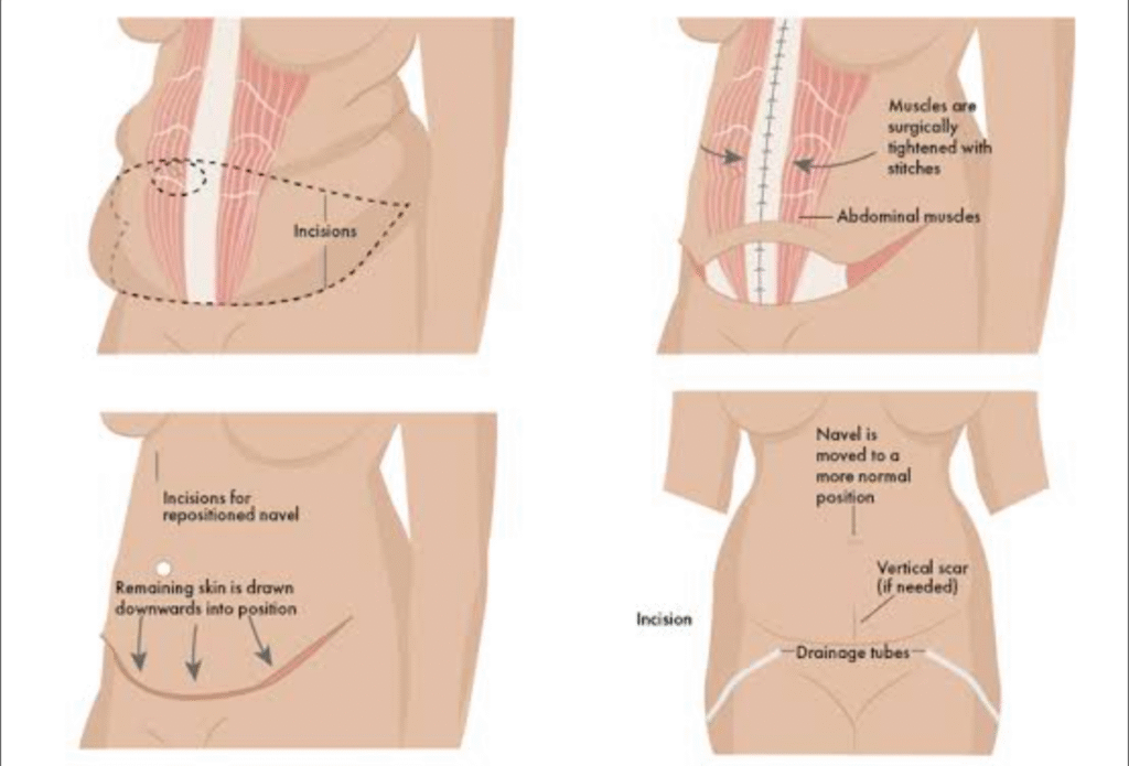 Tummy Tuck Recovery in Pennsylvania: A Patient's Journey