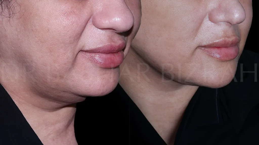 Facelift in Dubai