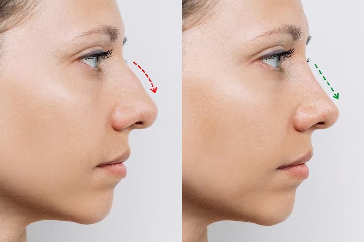An Overview of Rhinoplasty Surgery in Australia