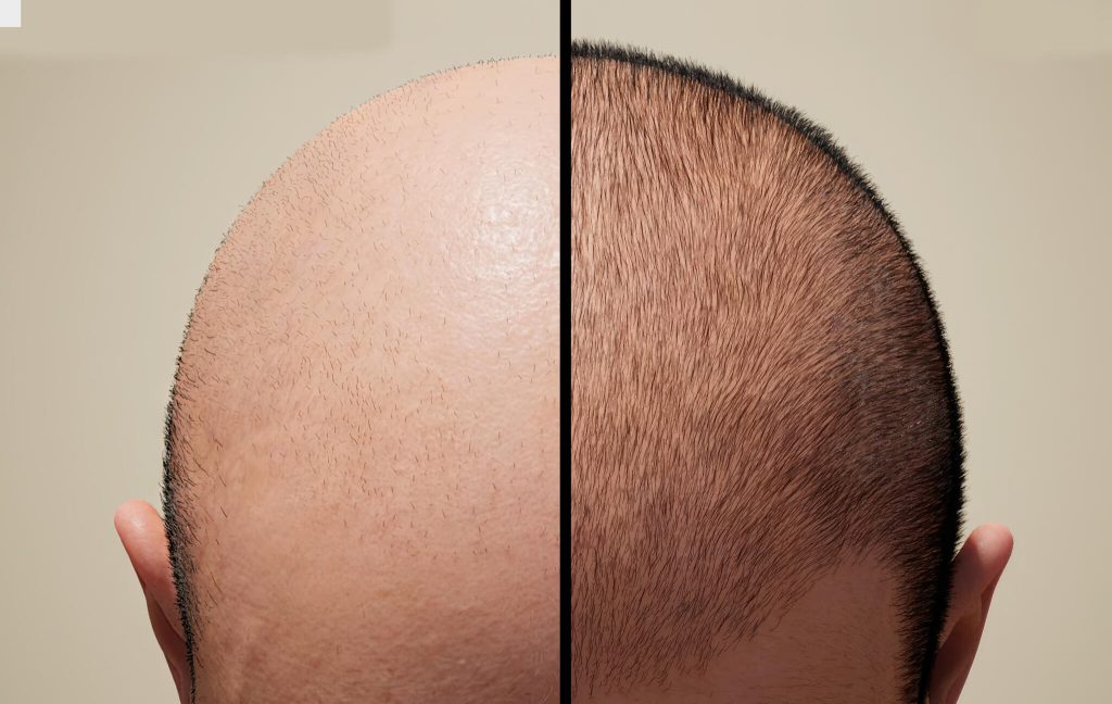 Debunking Common Myths About Hair Transplant Procedures