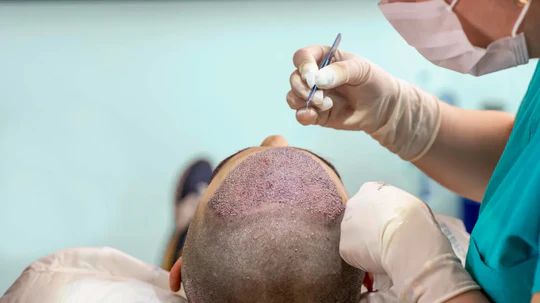Everything You Need to Know About Hair Transplants: A Comprehensive Guide