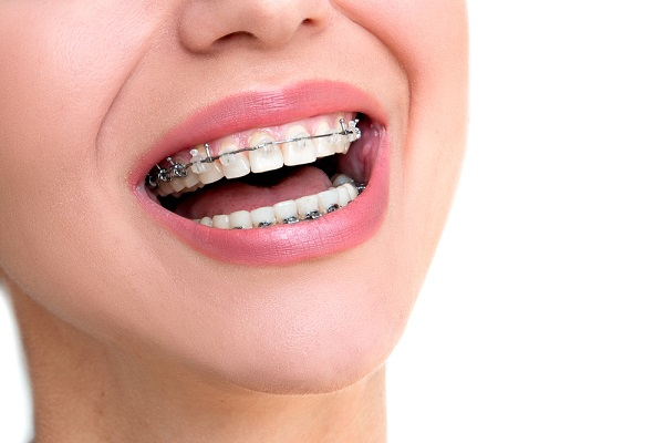 When Should You See an Orthodontist Altrincham for Crooked Teeth?