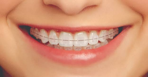 Could Clear Braces Oldham Help If Your Teeth Have Started to Shift?